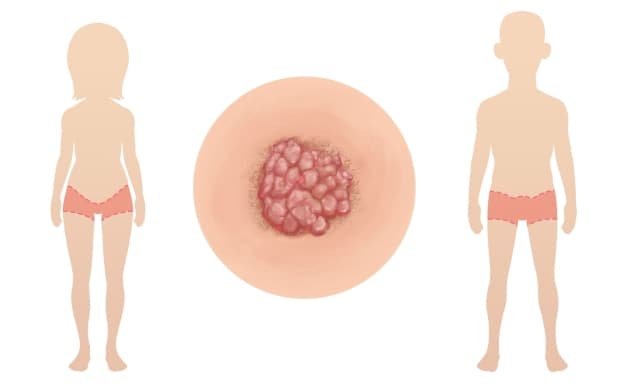 các đường lây nhiễm sùi mào gà là gì