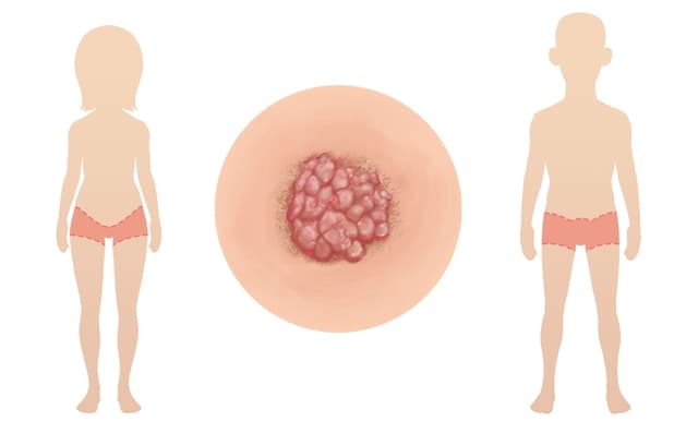 Các đường lây nhiễm sùi mào gà là gì?