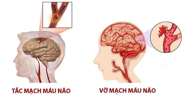 Phân loại để dễ điều trị tai biến mạch máu não