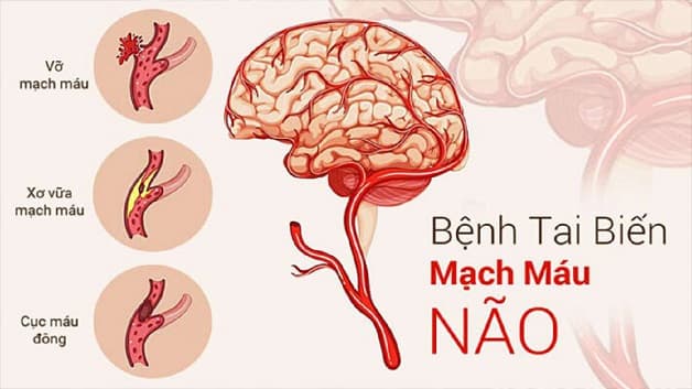 Nguyên nhân chính gây tai biến mạch máu não hay còn gọi đột quỵ não