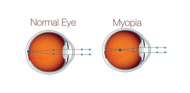 Tìm hiểu các tật khúc xạ về mắt thường gặp