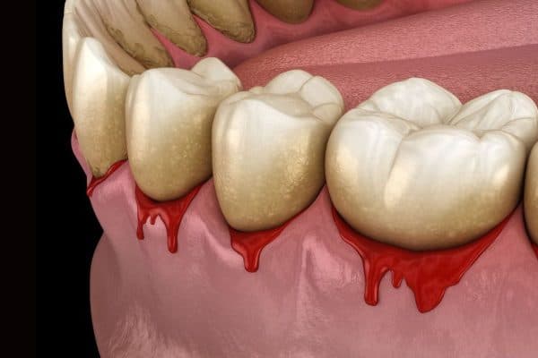 Không vệ sinh răng miệng tạo điều kiện để các vi khuẩn có hại tấn công và làm tổn thương các tổ chức răng, nướu