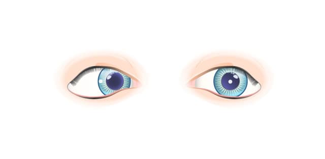 Cách điều trị lác mắt hiệu quả hiện nay