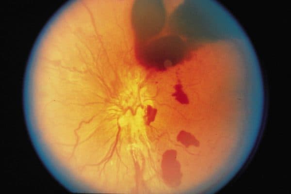 Xuất huyết dịch kính là tình trạng máu bị xuất huyết, chảy vào trong khoang chứa dịch kính của mắt