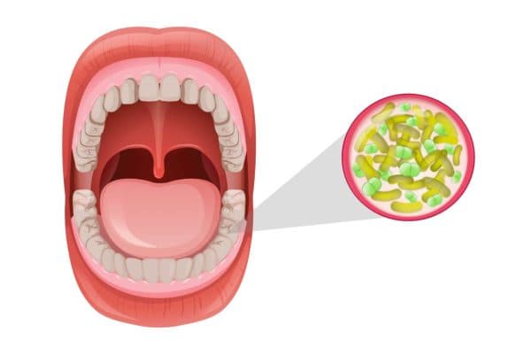 Vi khuẩn có hại từ các hố sâu răng trong khoang miệng phát triển quá mức sẽ dẫn tới tình trạng hôi miệng