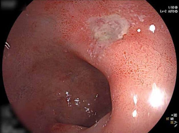 Hình ảnh nội soi nhận biết vết loét bao tử