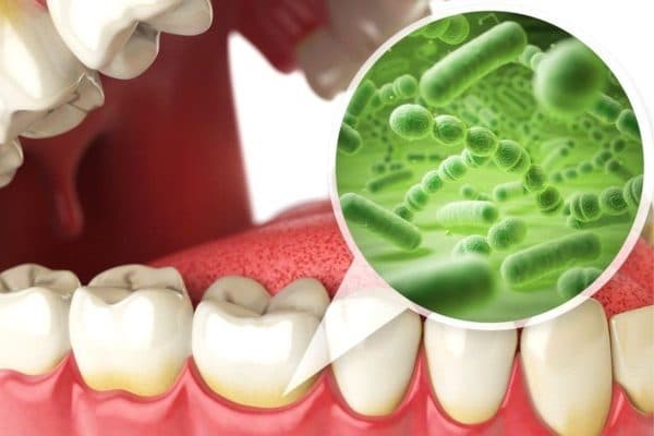 Vệ sinh răng miệng không đúng cách, không khoa học có thể dẫn tới cao răng