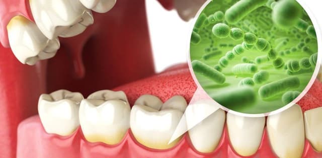 Cao răng là gì, có ảnh hưởng gì tới sức khỏe răng miệng không?