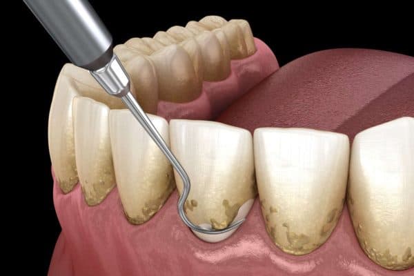 Cao răng là gì theo các chuyên gia chính là quá trình vôi hoá của các mảng bám, thức ăn thừa bám lâu trên răng