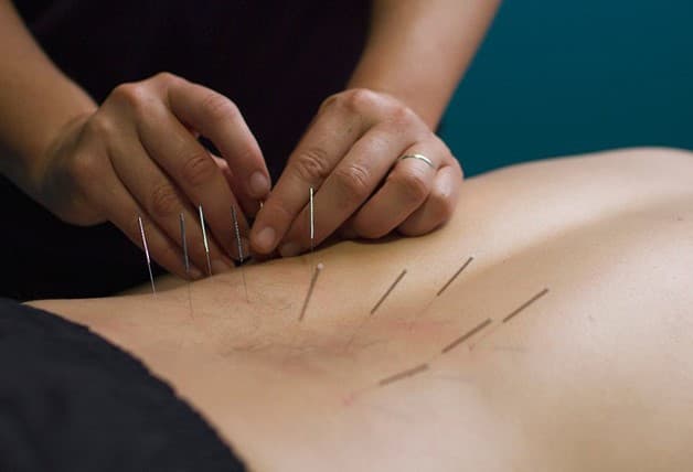 Điều trị thoái hóa cột sống lưng bằng châm cứu