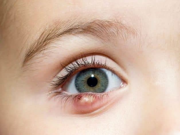 Lẹo là bệnh lý nhãn khoa mà trong đó, tuyến chân lông mi hoặc tuyến nhầy mí mắt bị viêm cấp tính