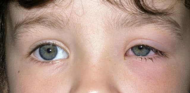 Dấu hiệu nhận biết viêm mí mắt dưới và cách điều trị