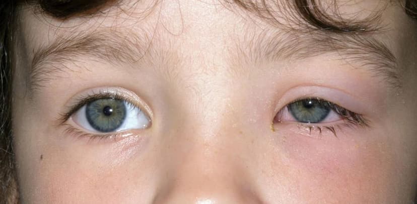 Dấu hiệu nhận biết viêm mí mắt dưới và cách điều trị