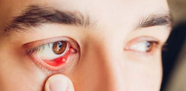 Triệu chứng và nguyên nhân bị đau mắt hột