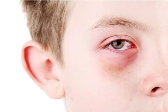 Chuyên gia giải đáp: Đau mắt đỏ bao lâu khỏi?