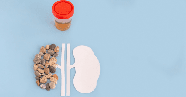 Tìm hiểu về cách chẩn đoán điều trị sỏi tiết niệu