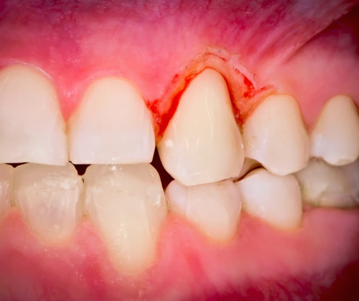 Điều trị viêm nướu cho từng giai đoạn