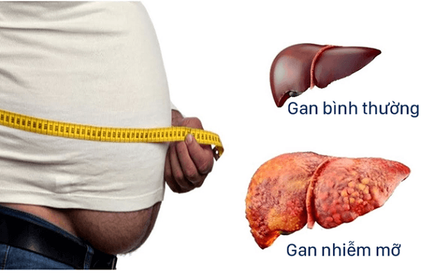 Gan nhiễm mỡ không do rượu