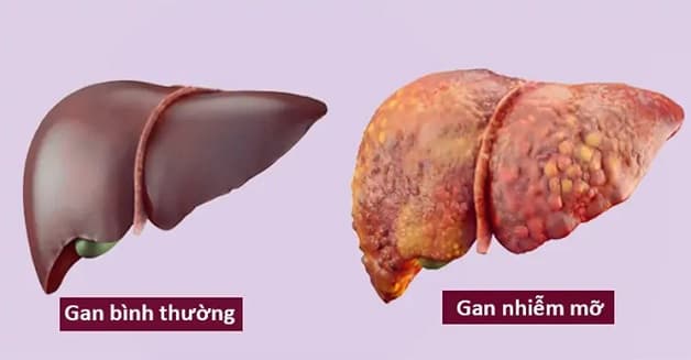 gan nhiễm mỡ