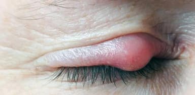 Dấu hiệu mắt nổi lẹo và cách điều trị an toàn, hiệu quả
