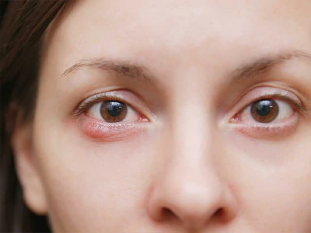 Tất tần tật những điều cần biết về bệnh glocom mắt