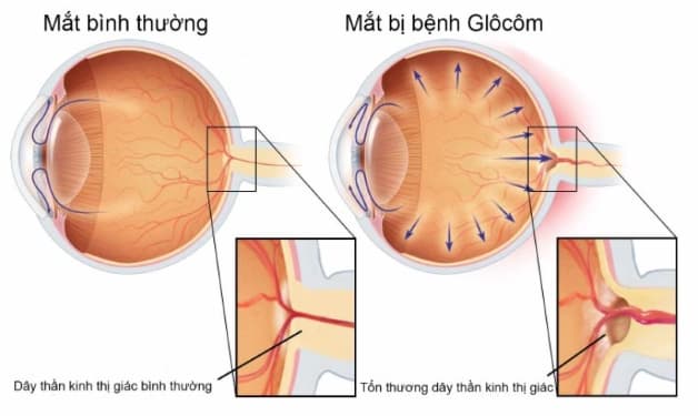 glocom mắt