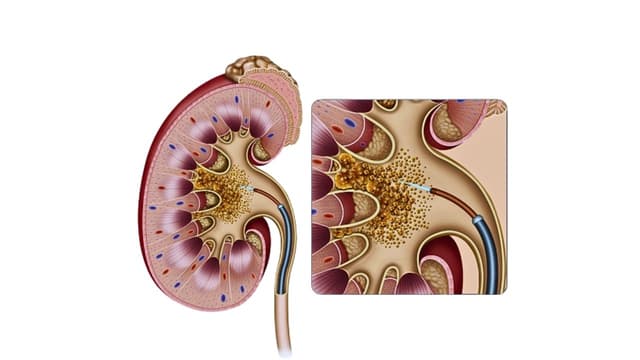 Hướng dẫn điều trị sỏi tiết niệu nhanh khỏi, tiết kiệm chi phí