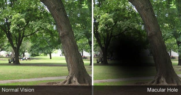 Hình ảnh trung tâm chỉ là một vùng đen, tối, giống như điểm mù