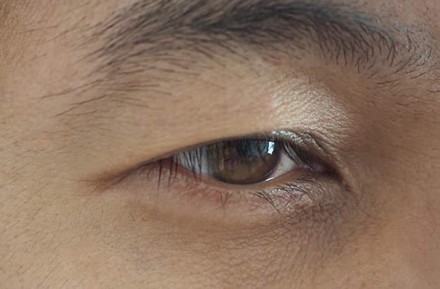 mắt bị sụp mí