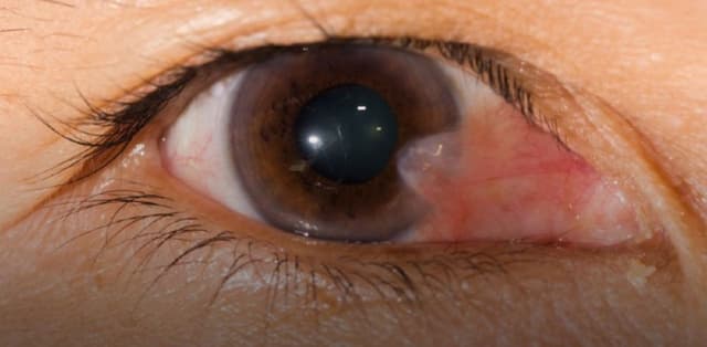 Bệnh mộng thịt ở mắt và cách điều trị