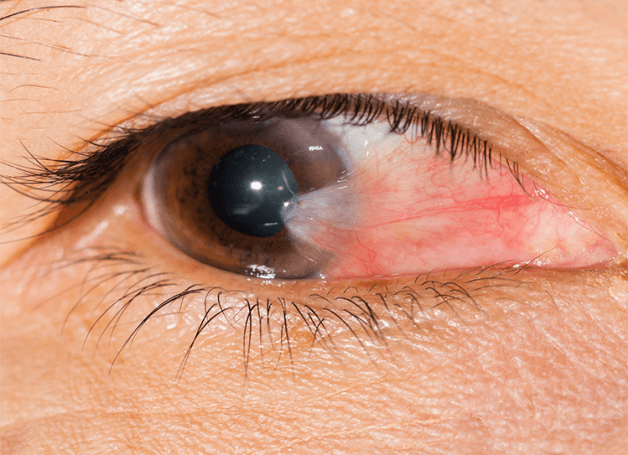 dấu hiệu mộng thịt ở mắt