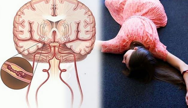 Nguy cơ tai biến mạch máu não ở các đối tượng từng bị
