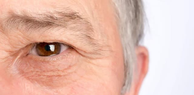 Tìm hiểu các nguyên nhân gây sụp mí mắt