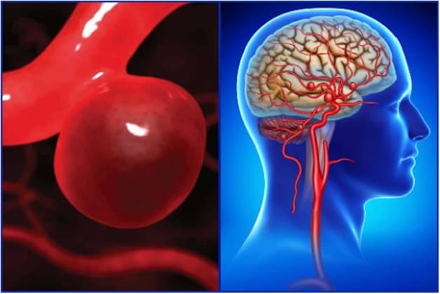 Nguyên nhân vỡ mạch máu não thường gặp