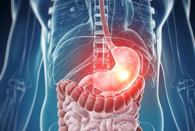 Viêm loét dạ dày tá tràng là bệnh phổ biến ở hệ tiêu hóa