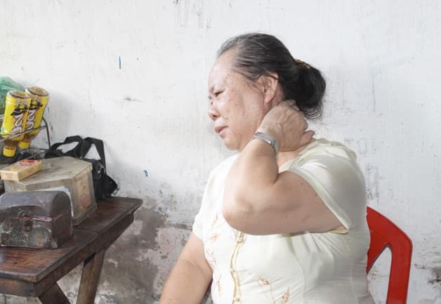 Người lớn tuổi có tỷ lệ mắc vôi sống đốt cổ cao hơn 