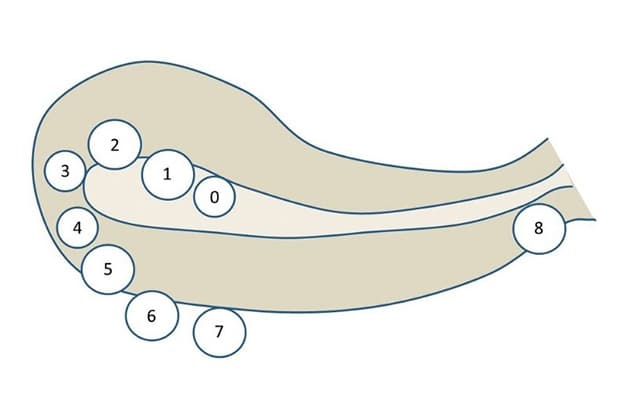 Nhân xơ tử cung loại 4 là khối nhân xơ nằm trong cơ tử cung