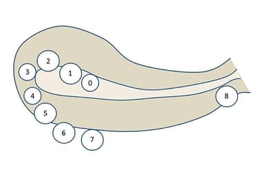 Bị u xơ tử cung, nhân xơ tử cung loại 4 có điều trị được không?