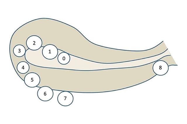 Bị u xơ tử cung, nhân xơ tử cung loại 4 có điều trị được không?