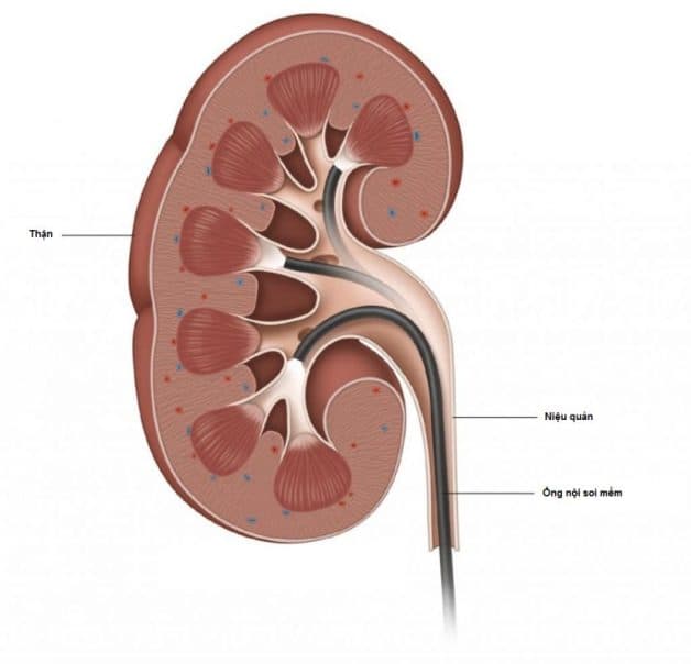 Những thông tin về những phương pháp điều trị sỏi tiết niệu