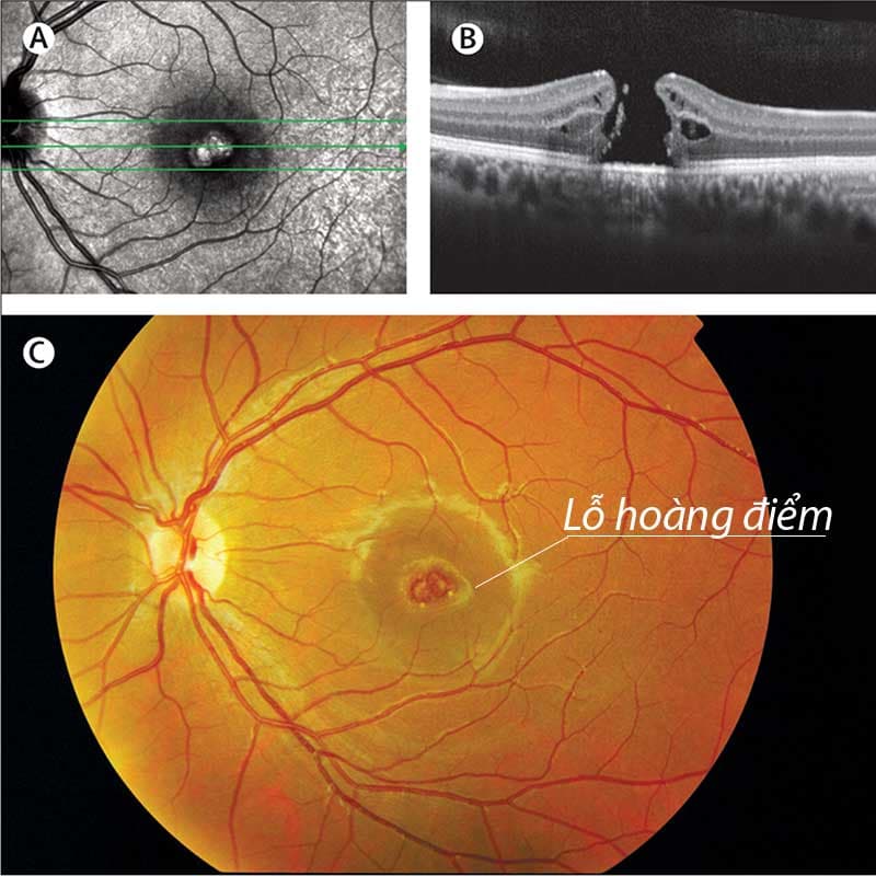 dịch kính võng mạc