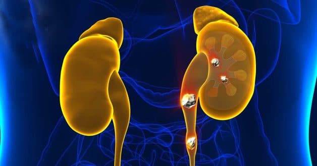 Sỏi niệu quản có tán được không và chi tiết cách tán sỏi