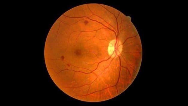 Khái niệm phù hoàng điểm dạng nang