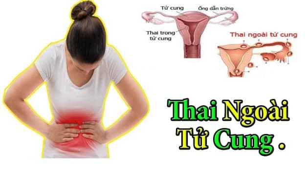 siêu âm chửa ngoài tử cung cần đi bệnh viện