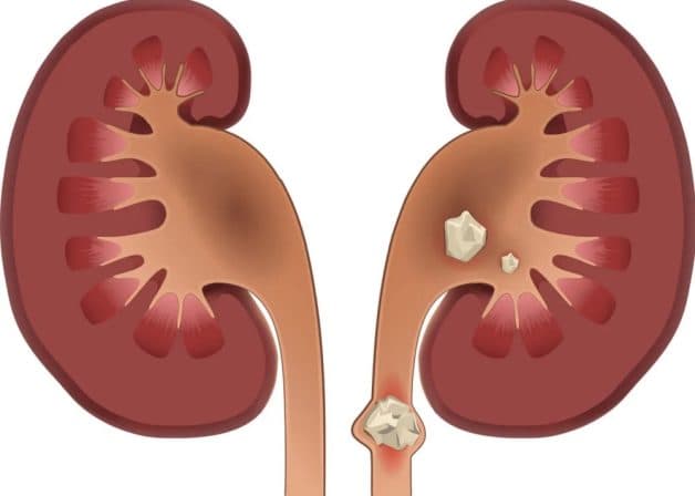 Hướng dẫn cách điều trị sỏi đường tiết niệu