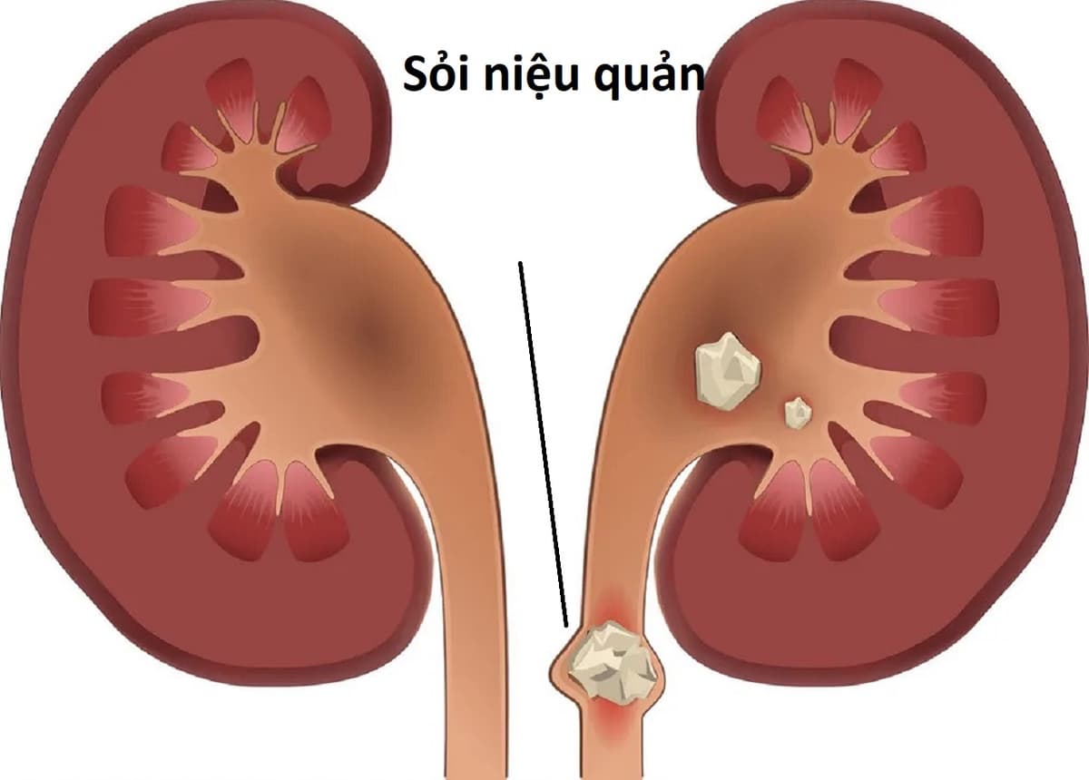 Giải đáp: Sỏi niệu quản có tán được không?