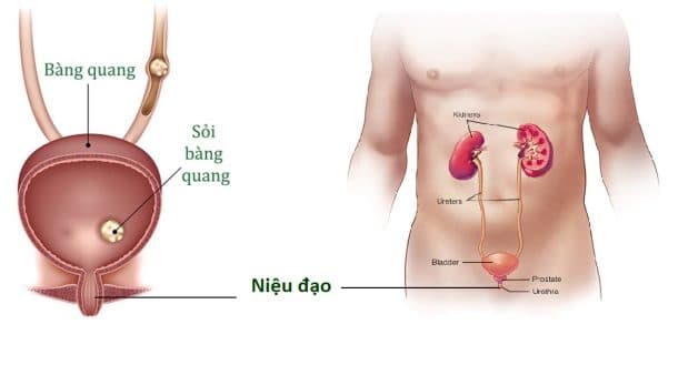 Thông tin quan trọng về tình trạng sỏi xuống niệu đạo