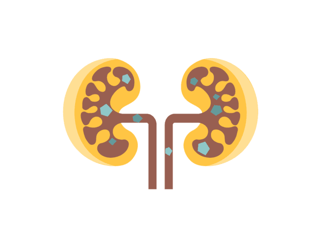 Những chỉ định điều trị sỏi thận cần lưu ý