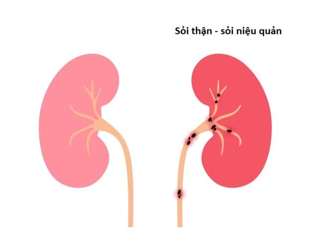 Chỉ định điều trị sỏi niệu quản theo từng giai đoạn bệnh