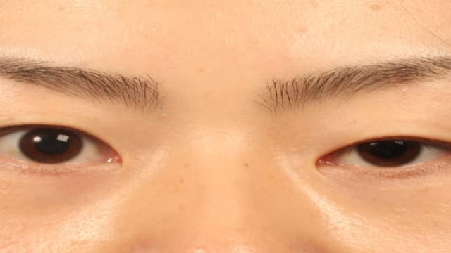 5 nguyên nhân sụp mí mắt và cách điều trị